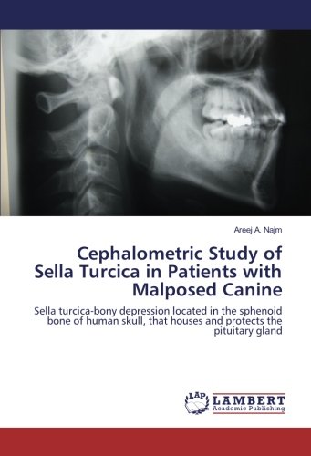 Cephalometric Study of Sella Turcica in Patients with Malposed Canine: Sella turcica-bony depression located in the sphenoid bone of human skull, that houses and protects the pituitary gland