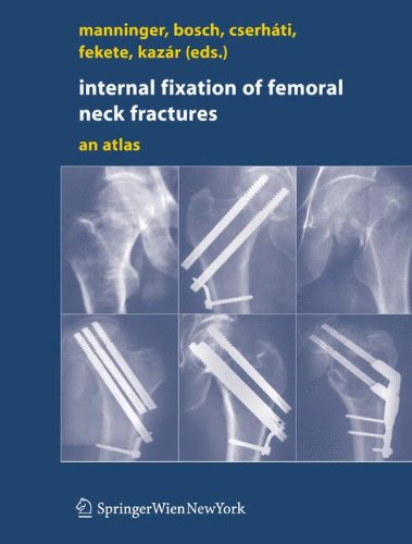 Internal fixation of femoral neck fractures: An Atlas