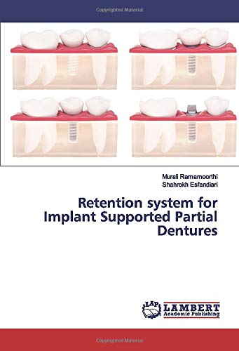 Retention system for Implant Supported Partial Dentures