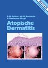 Atopische Dermatitis.