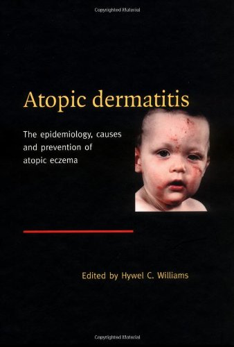 Atopic Dermatitis: The Epidemiology, Causes and Prevention of Atopic Eczema