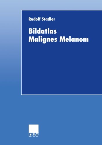 Bildatlas Malignes Melanom