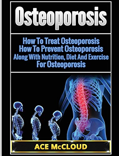 Osteoporosis: How To Treat Osteoporosis: How To Prevent Osteoporosis: Along With Nutrition, Diet And Exercise For Osteoporosis (Reverse or Prevent Bone Loss from Osteoporosis All)