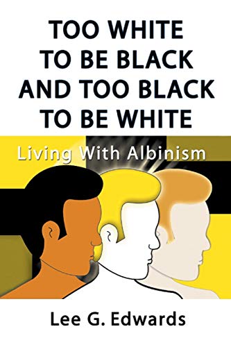Too White to be Black and too Black to be White: Living with Albinism