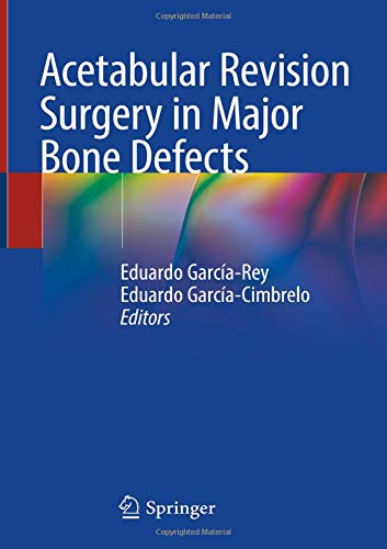 Acetabular Revision Surgery in Major Bone Defects
