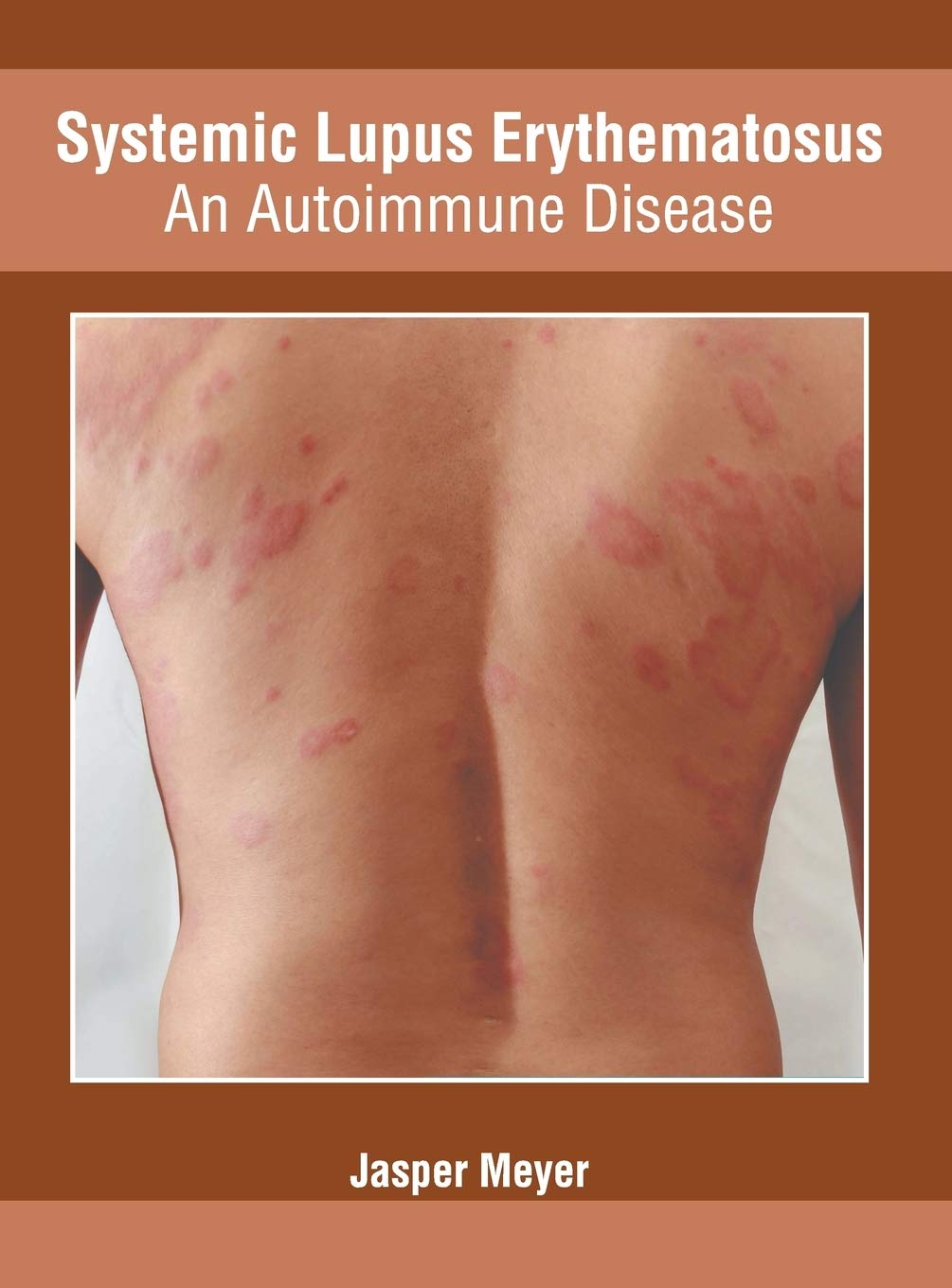 Systemic Lupus Erythematosus: An Autoimmune Disease