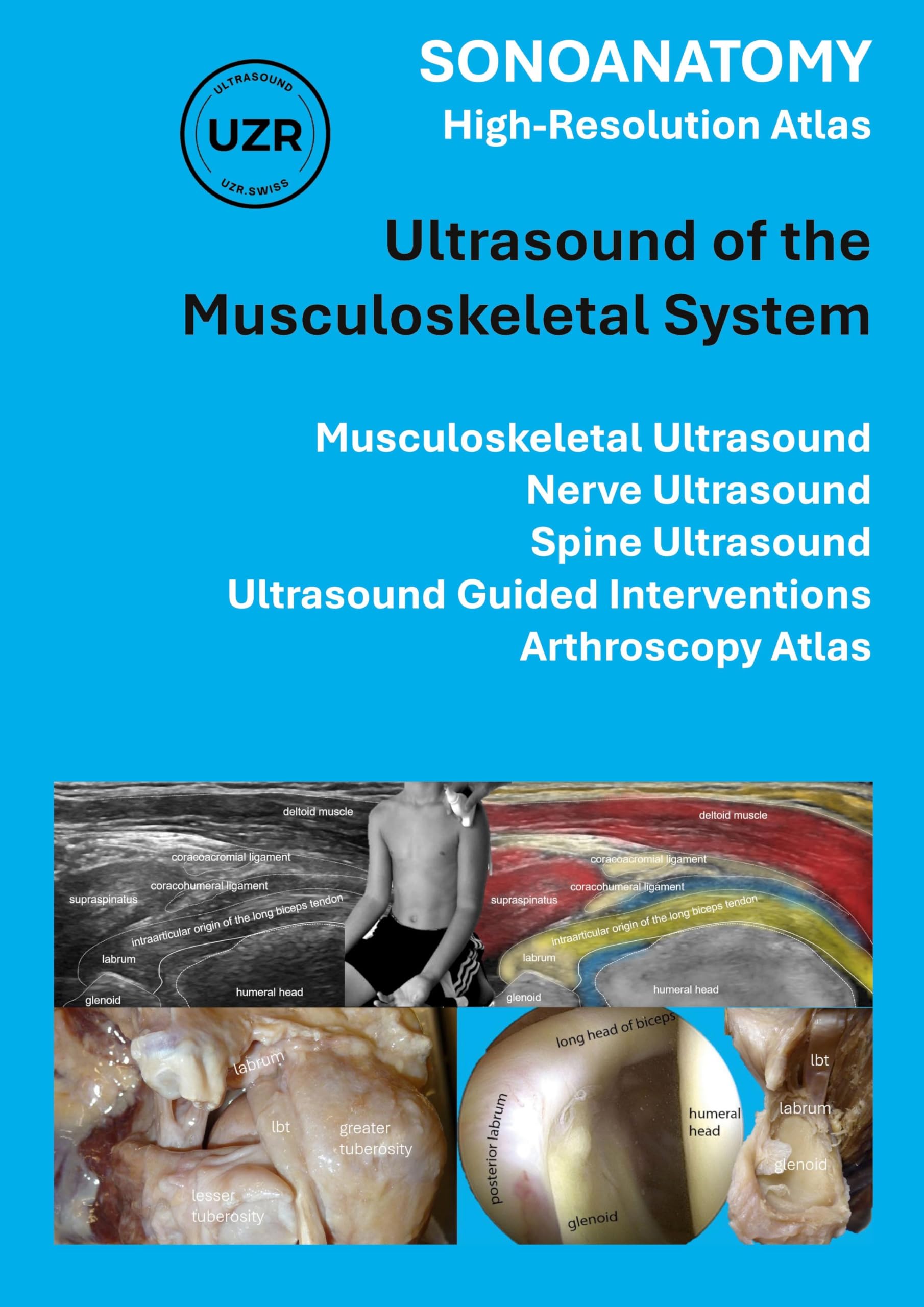 SONOANATOMY - High-Resolution Atlas - Ultrasound of the Musculoskeletal System: Musculoskeletal Ultrasound, Nerve Ultrasound, Spine Ultrasound, Ultrasound Guided Interventions, Arthroscopy Atlas