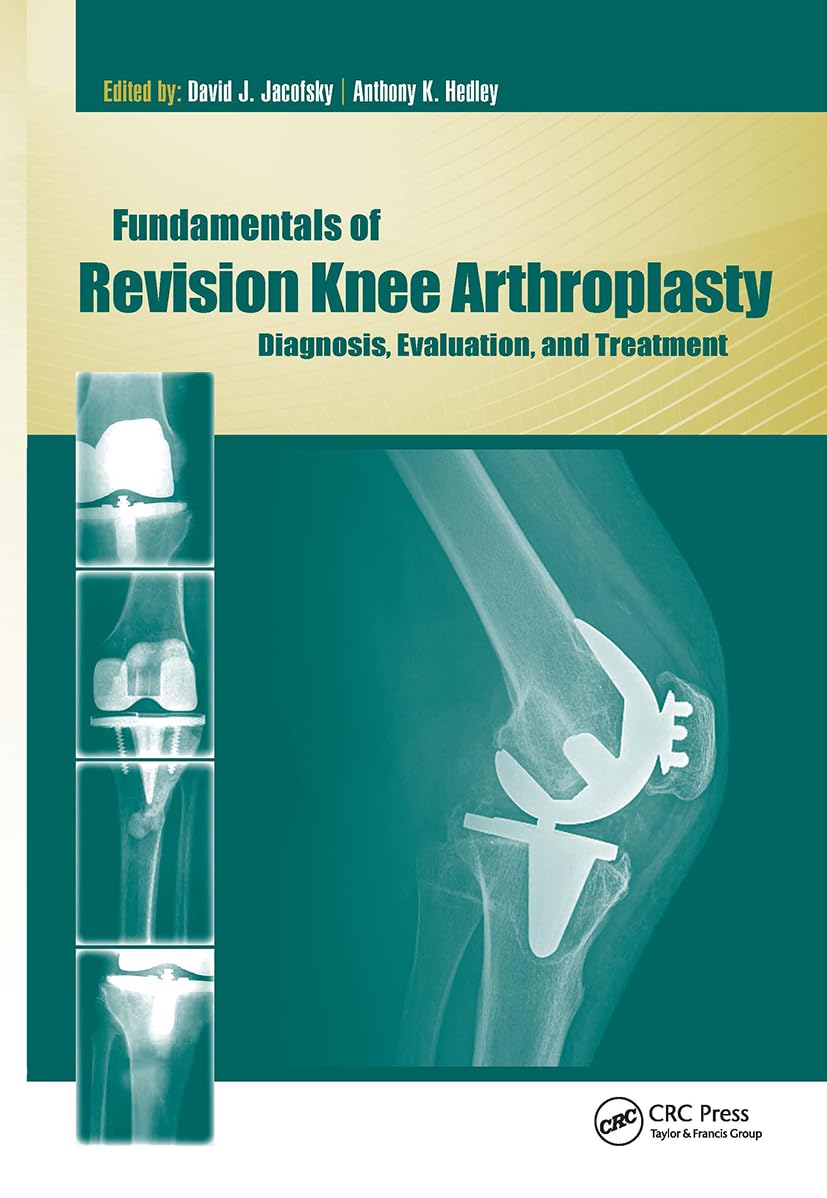 Fundamentals of Revision Knee Arthroplasty: Diagnosis, Evaluation, and Treatment