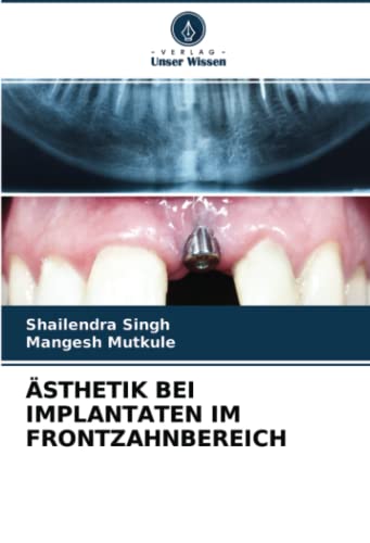 ÄSTHETIK BEI IMPLANTATEN IM FRONTZAHNBEREICH: DE