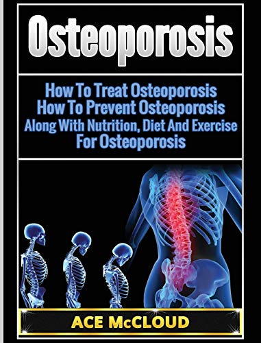 Osteoporosis: How To Treat Osteoporosis: How To Prevent Osteoporosis: Along With Nutrition, Diet And Exercise For Osteoporosis (Reverse or Prevent Bone Loss from Osteoporosis All)