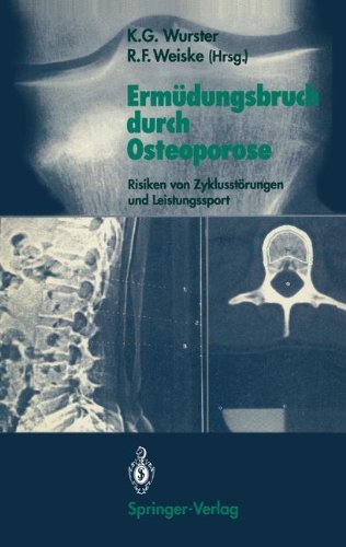 Ermüdungsbruch durch Osteoporose: Risiken von Zyklusstörungen und Leistungssport (German Edition)