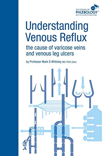 Understanding Venous Reflux the Cause of Varicose Veins and Venous Leg Ulcers: Varicose veins and venous leg ulcers (College of Phlebology)