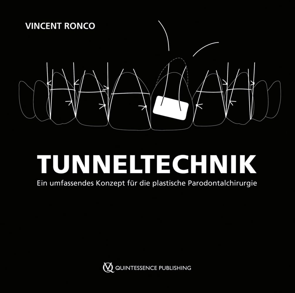 Tunneltechnik: Ein umfassendes Konzept für die plastische Parodontalchirurgie