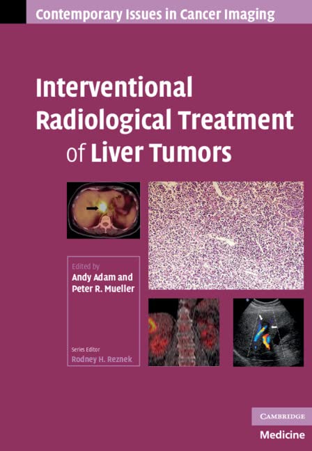 Interventional Radiological Treatment of Liver Tumors (Contemporary Issues in Cancer Imaging)