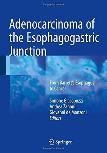 Adenocarcinoma of the Esophagogastric Junction: From Barrett's Esophagus to Cancer