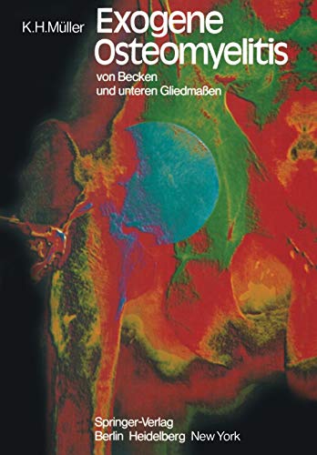 Exogene Osteomyelitis von Becken und unteren Gliedmaßen: Besonderheiten Pathogenese Klinik Therapie Ergebnisse