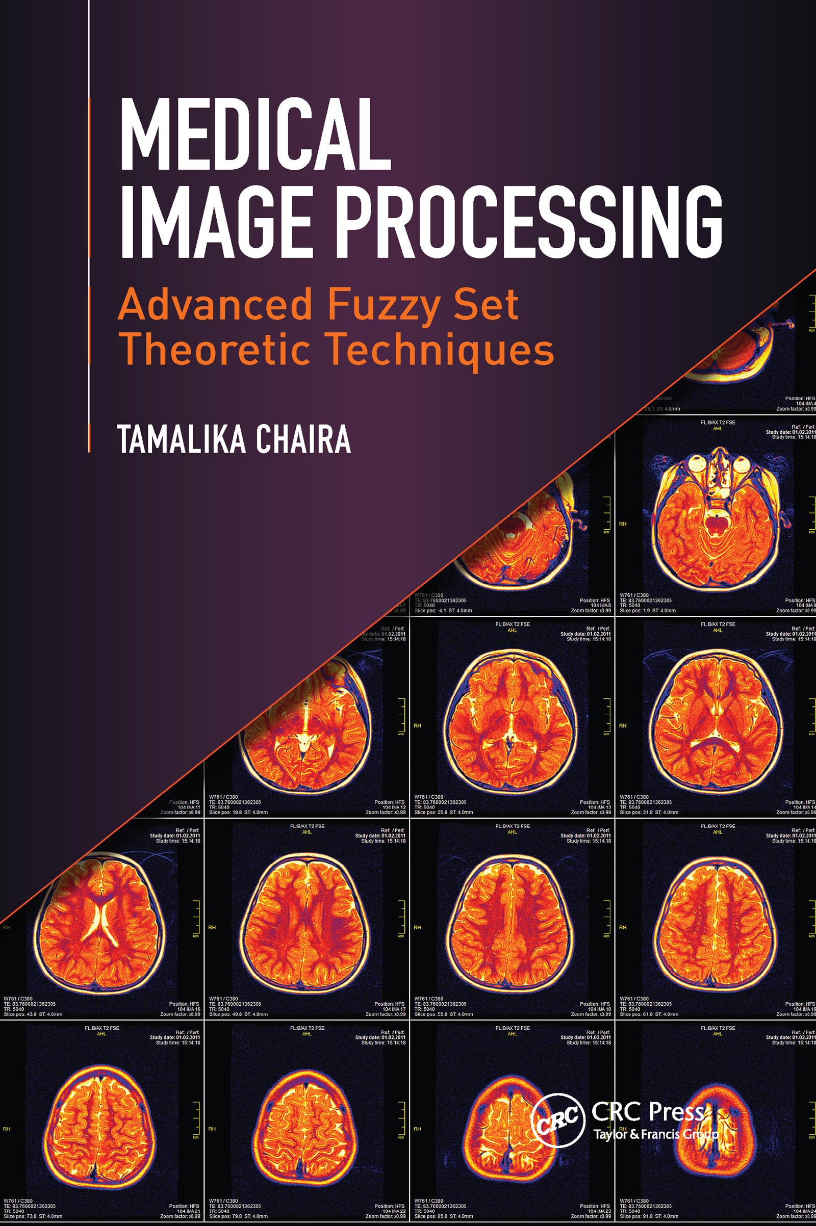 Medical Image Processing: Advanced Fuzzy Set Theoretic Techniques