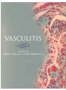 Vasculitis