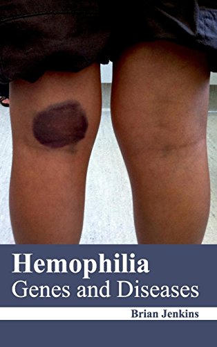 Hemophilia: Genes and Diseases
