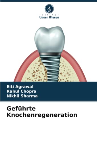 Geführte Knochenregeneration: DE