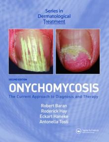 Onychomycosis: The Current Approach to Diagnosis and Therapy (Series in Dermatological Treatment)