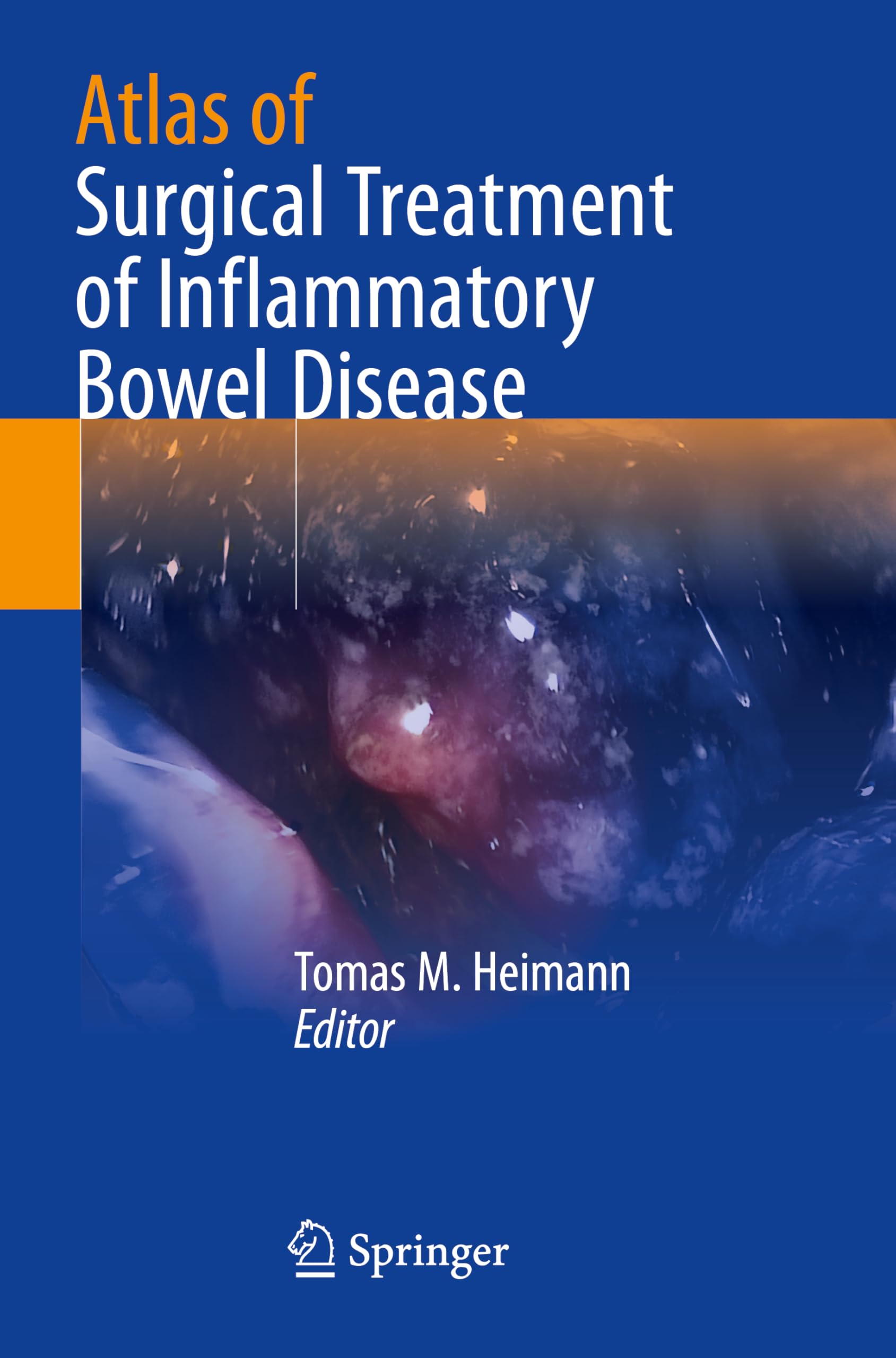 Atlas of Surgical Treatment of Inflammatory Bowel Disease: DE