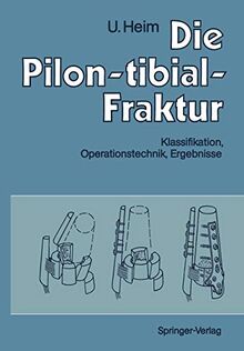 Die Pilon-tibial-Fraktur: Klassifikation, Operationstechnik, Ergebnisse (German Edition)