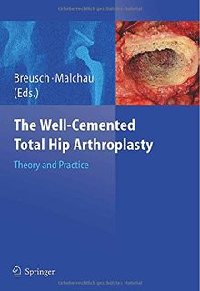 The Well-Cemented Total Hip Arthroplasty: Theory and Practice
