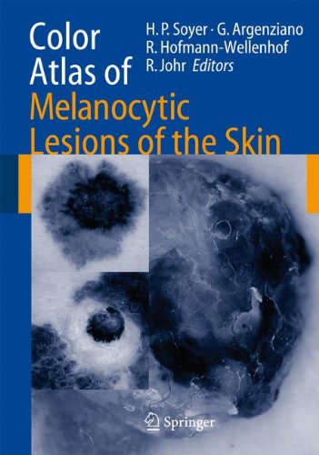 Color Atlas Of Melanocytic Lesions Of The Skin